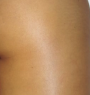 After treatment
