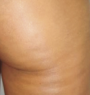 Before treatment
