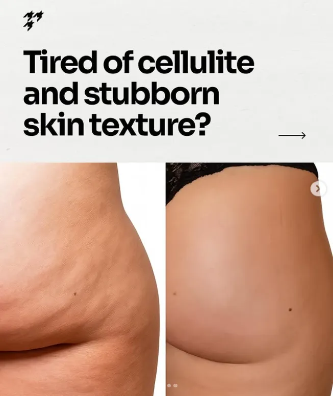 anti cellulite massage before after